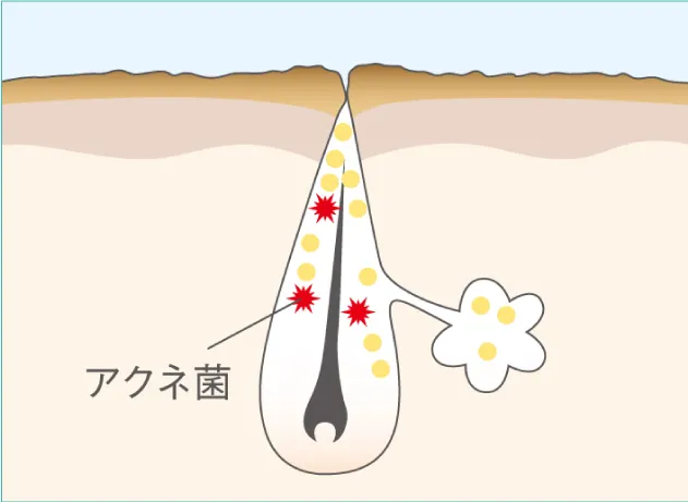 ②毛穴の入口がふさがる