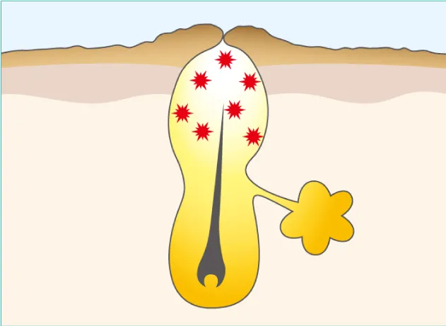 ③毛穴内に皮脂がたまる（白ニキビ）