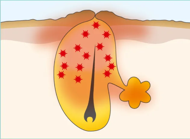 ④アクネ菌が繁殖し、炎症が起きる（赤ニキビ）
