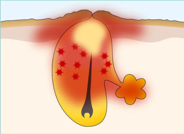 ⑤炎症が悪化し、膿が溜まる（膿胞ニキビ）