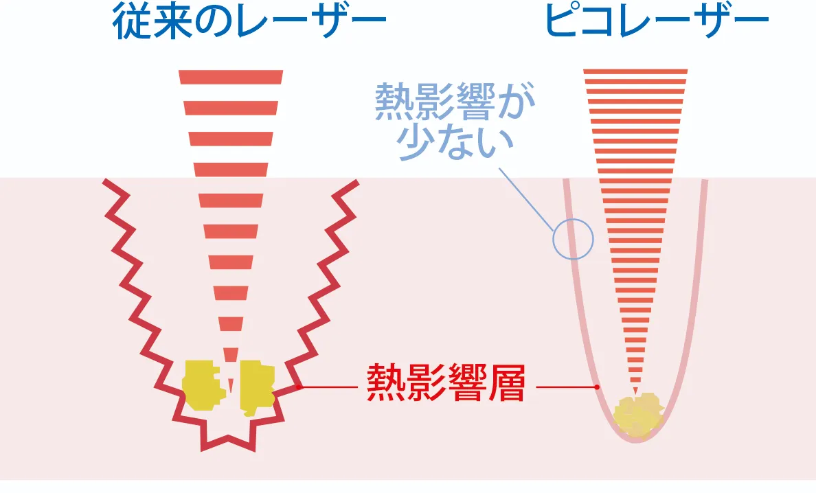 従来のレーザーとピコレーザー